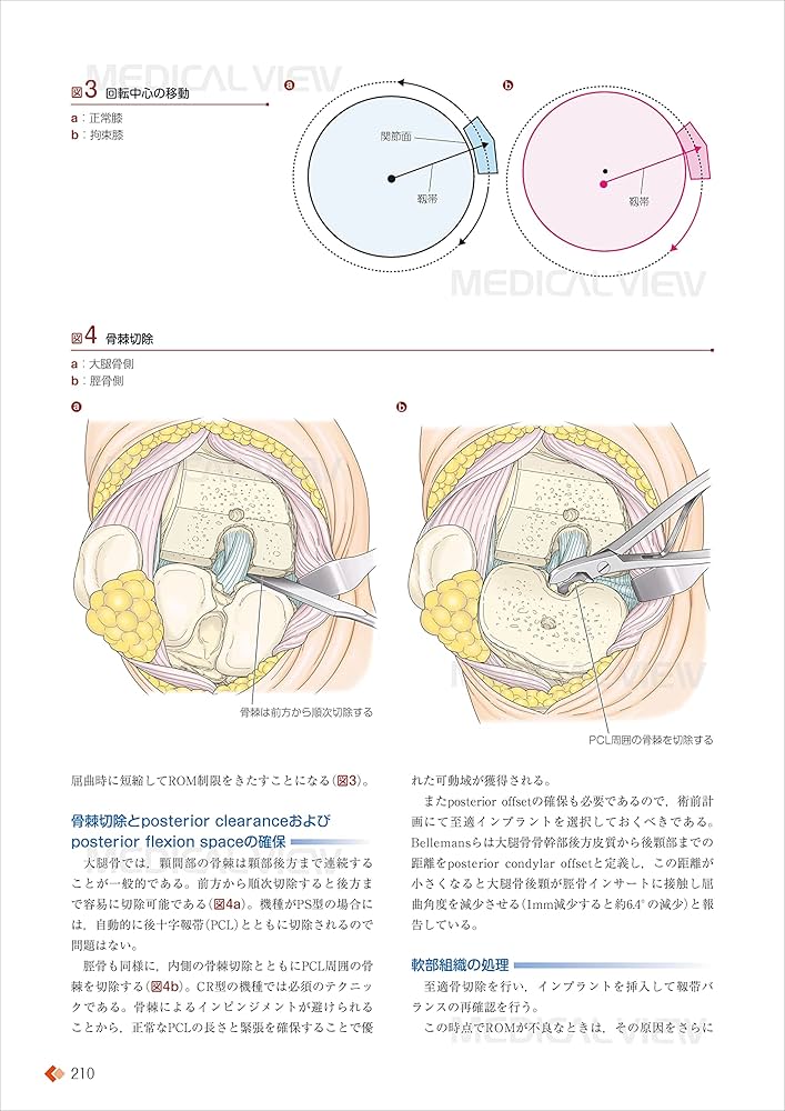 人工膝関節全置換術[TKA]のすべて−より安全に・より確実に
